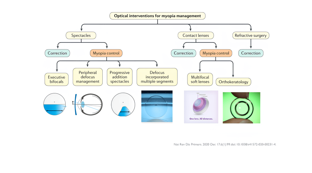 แผนผังแสดงทางเลือกทางทัศนมาตรในการจัดการสายตาสั้น ทั้งแบบแก้ไขการมองเห็นและแบบ ชะลอสายตาสั้นในเด็ก ด้วยแว่นตาและคอนแทคเลนส์ประเภทต่างๆ