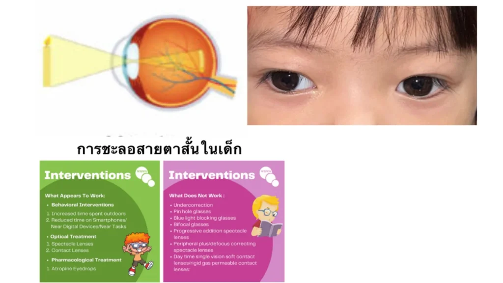ภาพแสดงการชะลอสายตาสั้นในเด็ก