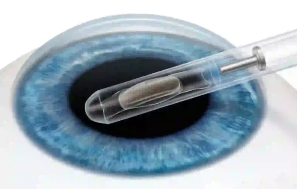 Phakic Intraocular Lens (PIOL)