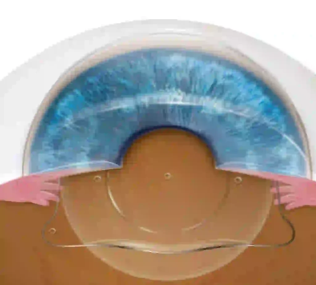 การผ่าตัดแก้ไขสายตาแบบภายในลูกตา Phakic Intraocular Lens (PIOL)